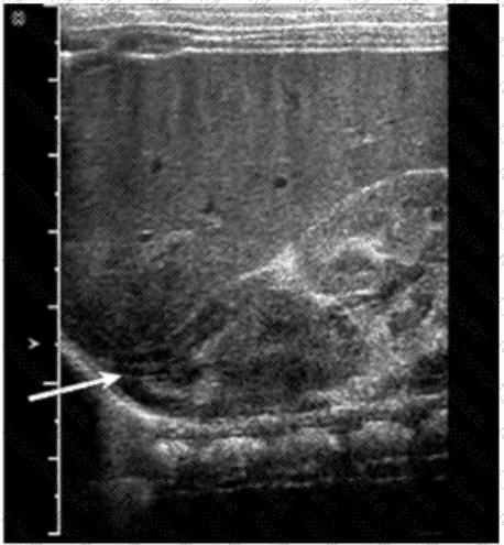 AB-Abdomen Question 23