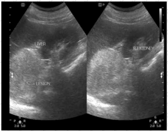 AB-Abdomen Question 44
