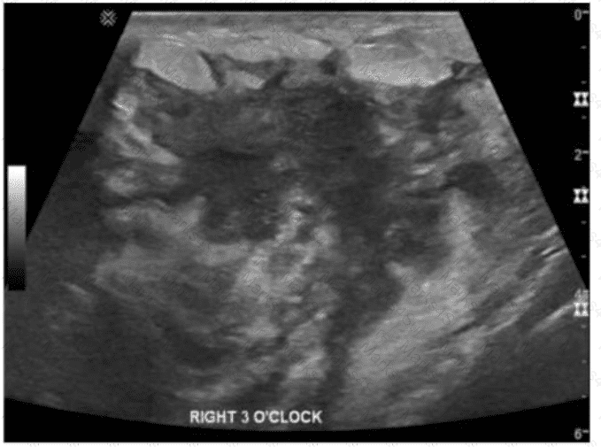 AB-Abdomen Question 43