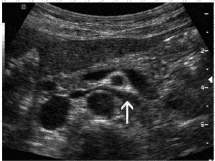 AB-Abdomen Question 45