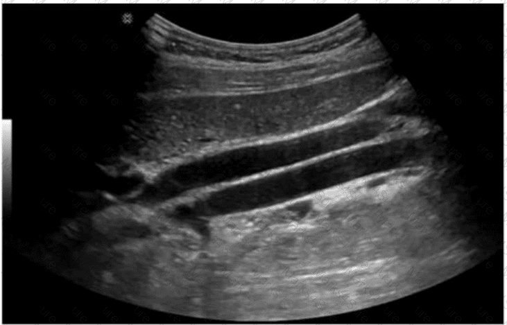 AB-Abdomen Question 38