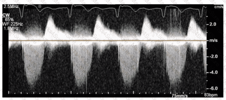 AE-Adult-Echocardiography Question 33