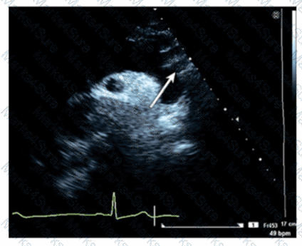 AE-Adult-Echocardiography Question 29