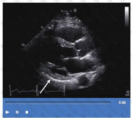 AE-Adult-Echocardiography Question 33