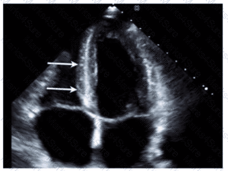AE-Adult-Echocardiography Question 15