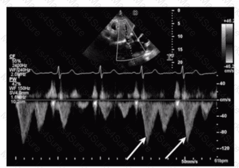 AE-Adult-Echocardiography Question 10